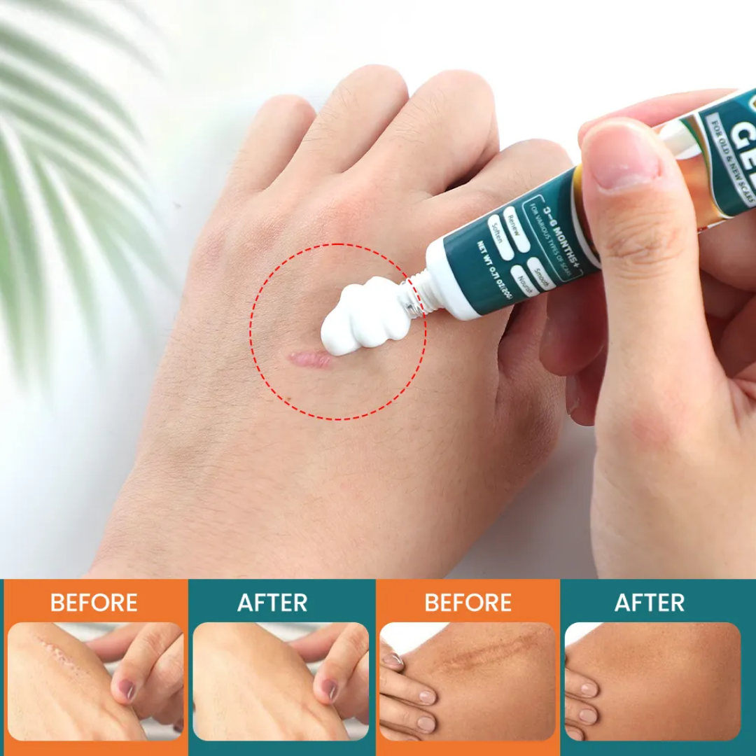 Créme magique traite les cicatrice ancienne et récente, vergetures,acnés, cheloïde, boutons...